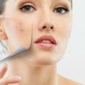 Избавиться от купероза на лице